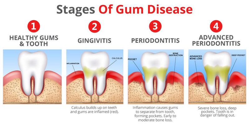 gum disease stages