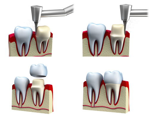 Dental Crown Procedure